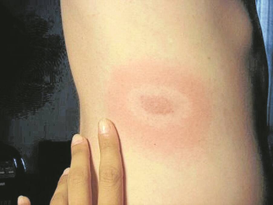 A BULLSEYE rash similar to this appeared on Isabelle’s back.