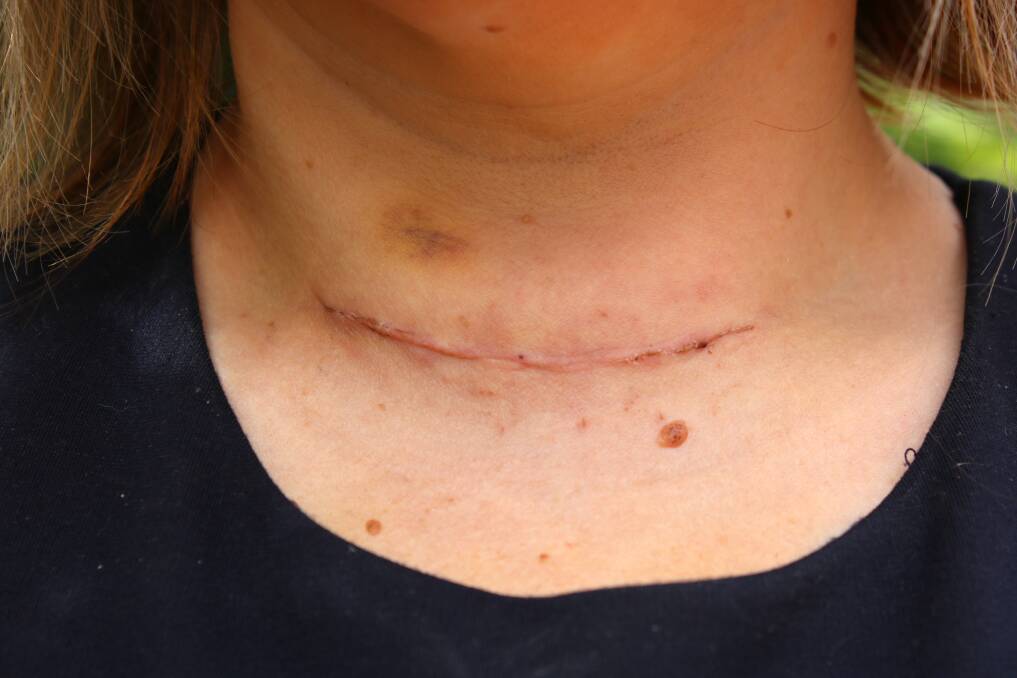 The cut at the base of Katie's neck is healing well after surgery. Photo: Vanessa Höhnke