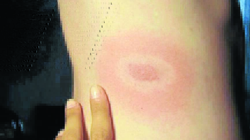 A bullseye rash is a telltale sign of Tick-borne Lyme Disease. A rash similar to this appeared on Isabelle Parish’s back after a camping trip in the Pilliga Forest.